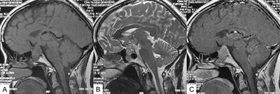 Clinical Parameters of Silent Corticotroph Adenomas With Positive and Negative Adrenocorticotropic Hormone Immunostaining: A Large Retrospective Single-Center Study of 105 Cases